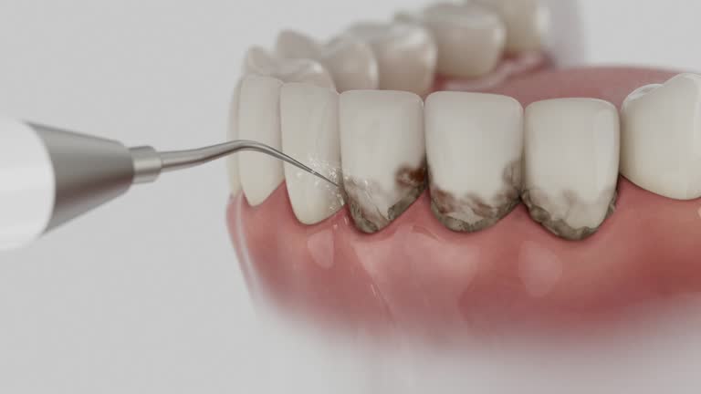 Reliable Tooth Extraction contractor in Beesleys Point, NJ by Smile Center Dentistry